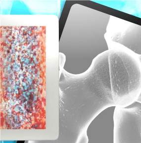 Avasküler Nekroz Nedir? Avasküler Nekroz’da Kök Hücre Tedavisi