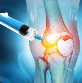 Dize Kök Hücre Tedavisi diz kireçlenmesini, diz ağrılarını ve hareket kısıtlığını gidermekte etkilidir