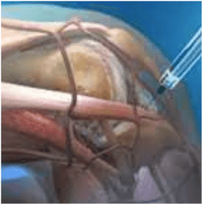 Kök hücre tedavileri diz ve eklem protezlerine alternatif bir tedavi yöntemi