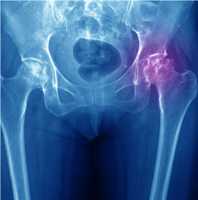 Femur Başının Avasküler Nekrozunda Kök Hücre Tedavisi