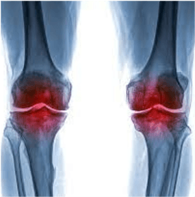 Diz ve Kalça Kireçlenmesinde Kök Hücre Tedavisi