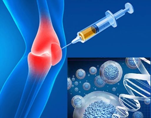 Ameliyatsız Kireçlenme Tedavisi